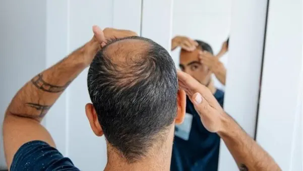 Dutasteride For Hair Loss: Side Effects, Dosage And More
